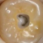 conservative microscope endodontic access molar